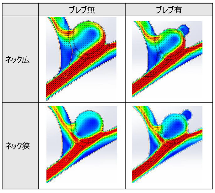 Simcenter FLOEFD ソリューション事例 脳動脈瘤のある血管内の流体解析