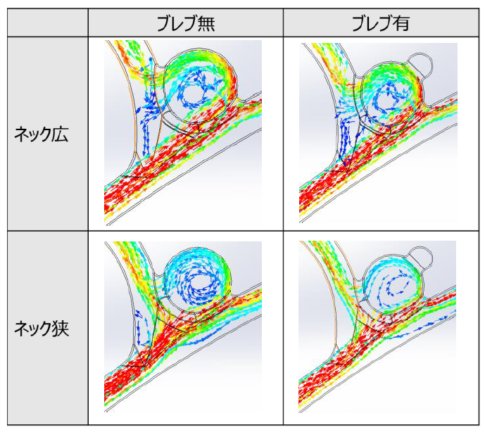 Simcenter FLOEFD ソリューション事例 脳動脈瘤のある血管内の流体解析